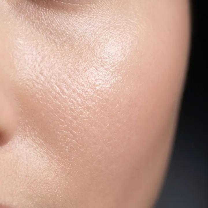 Microneedling